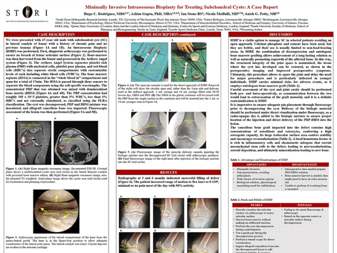 Minimally Invasive Intraosseous Bioplasty for Treating Subchondral Cysts: A Case Report